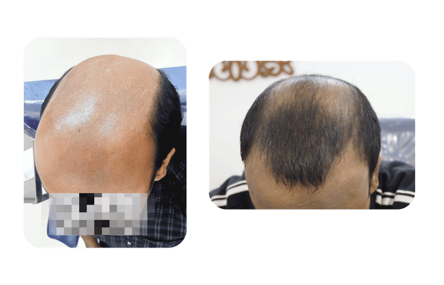 3 Month PRP Hair Restoration - First & Last Session