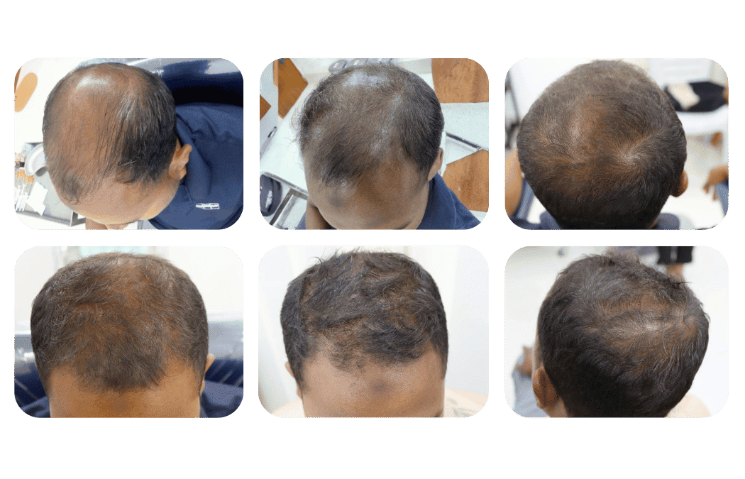 Case study- PRP Therapy progress by sessions - The Skin Lab BD Khulna Bangladesh