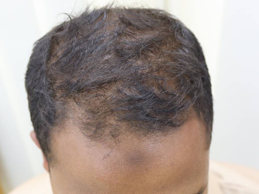 Session 5: PRP Therapy- The SkinLab BD