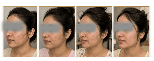 4-week renewal - Chemical Peel Casse Study