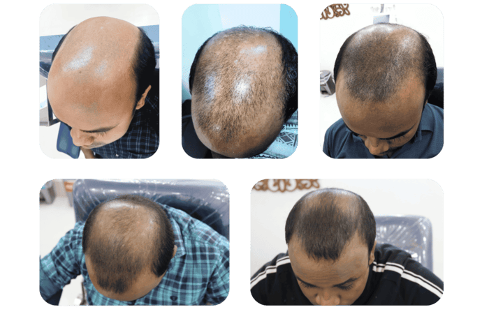 Best PRP Hair Treatment in Khulna: 3-Month sessions PRP Hair Restoration Journey