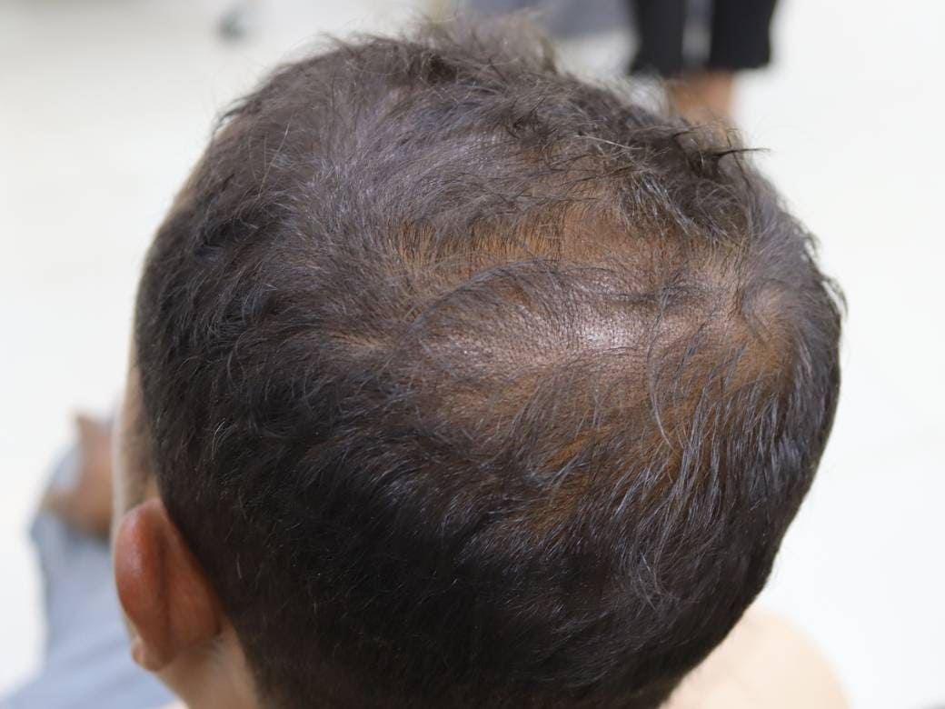 Session 6: PRP Therapy- The SkinLab BD