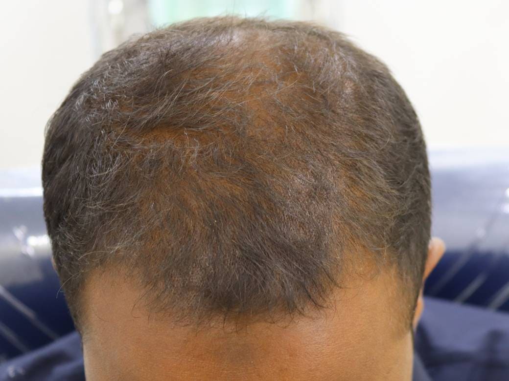 Session 4: PRP Treatment - The SkinLab BD
