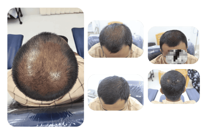 Patchy Hair loss - Treating Alopecia Areata - The Skin Lab BD