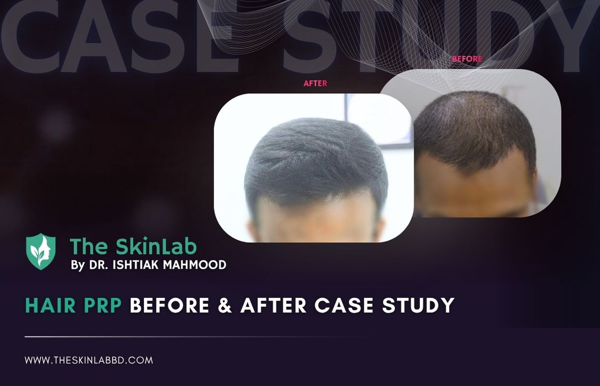 Hair PRP Before & After Case Study - The Skin Lab BD