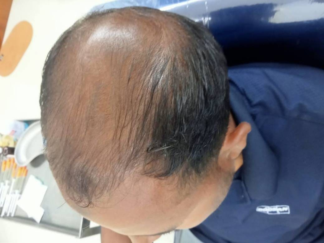 Session 1: PRP Treatment - The SkinLab BD