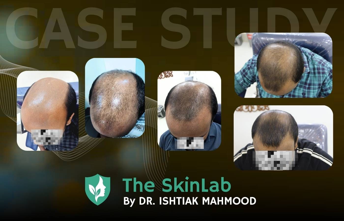 From 5 Years of Thinning to Confidence: 3-Month PRP Hair Restoration Journey