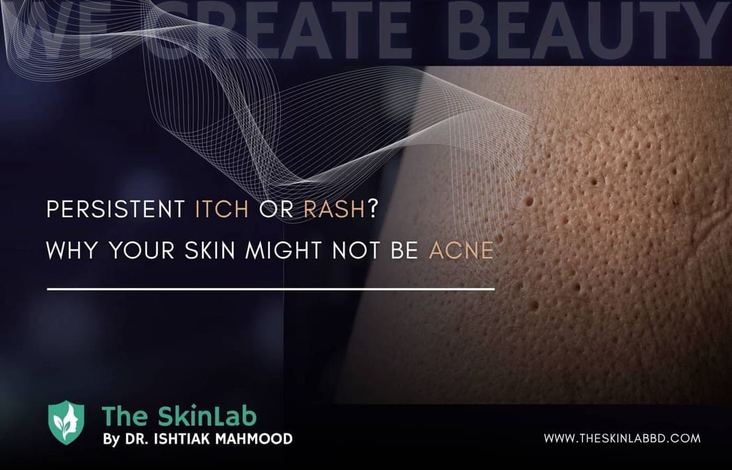 Persistent Itch or Rash? Why Your Skin Might Not Be Acne