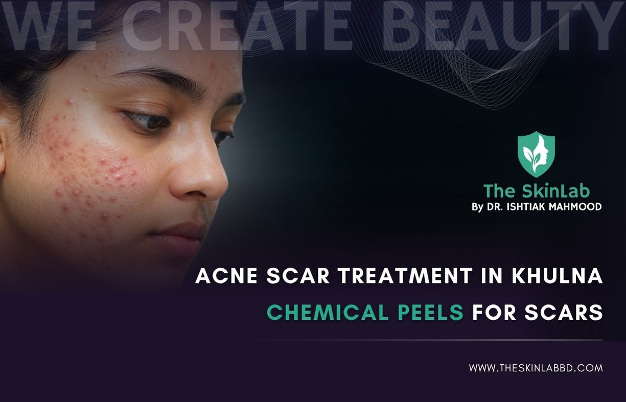 Acne Scar Treatment in Khulna - Chemical Peels for Scars