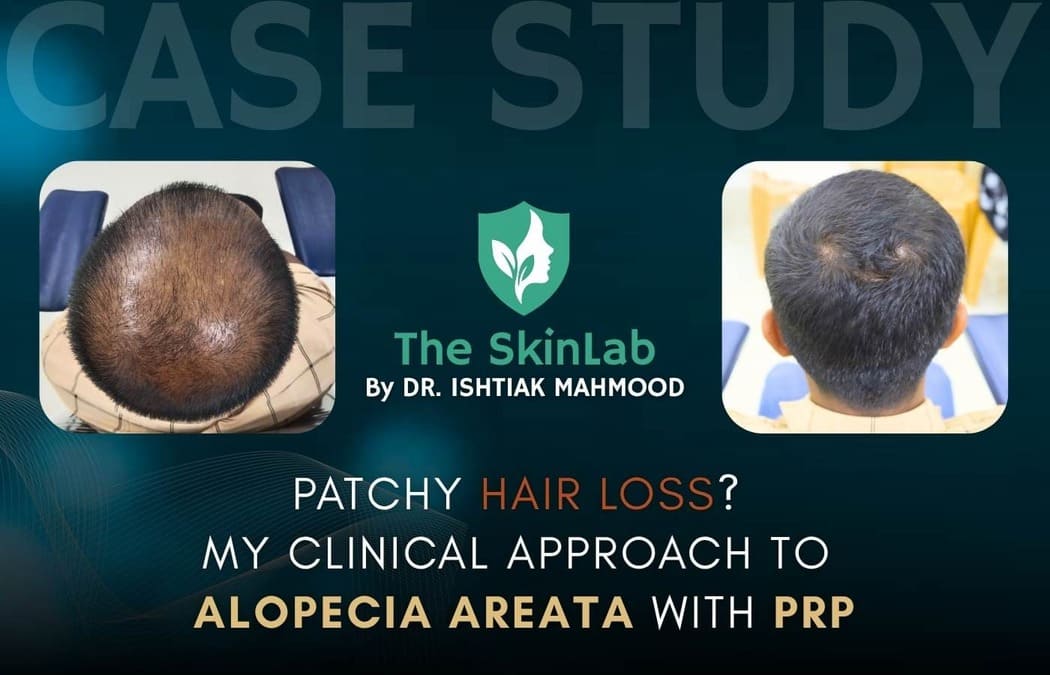 The Sudden Patch: A Clinical Case Study on Alopecia Areata