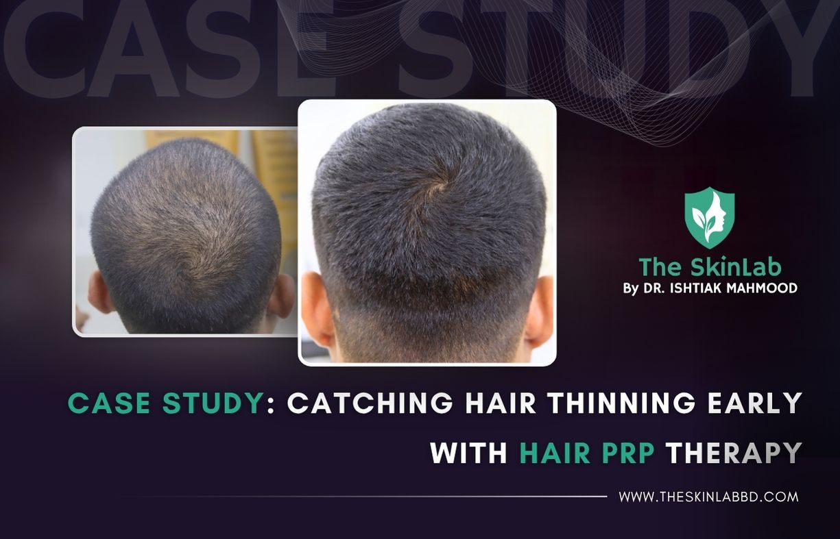 Case Study: Catching Hair Thinning Early with PRP Therapy