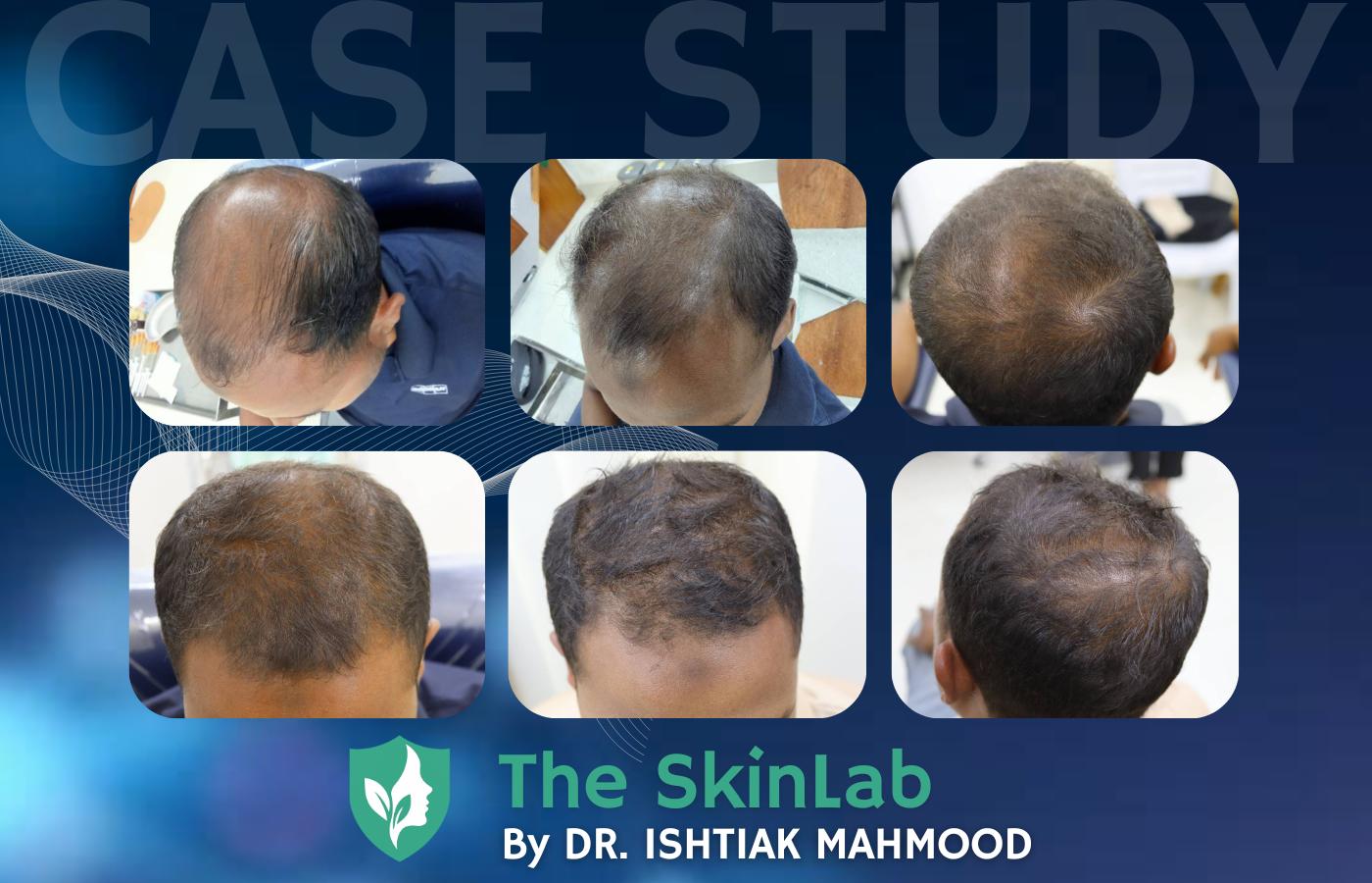 Beyond the Surface: A Journey of Hair Restoration
