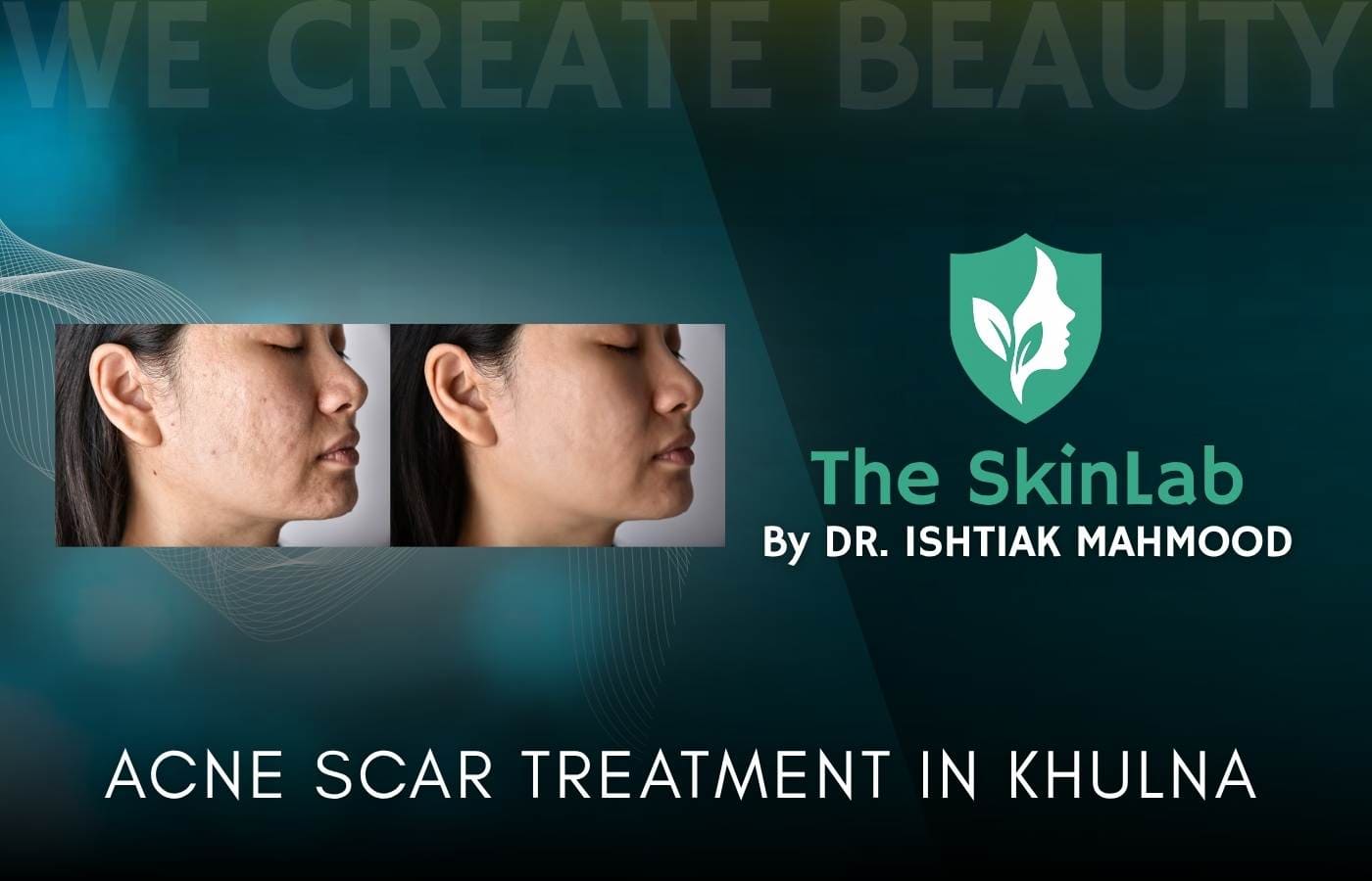 Acne Scar Treatment in Khulna