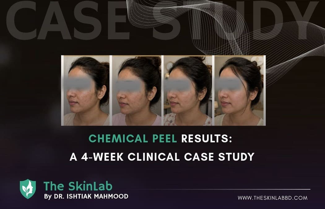 The 4-Week Renewal: A Clinical Peel Case Study